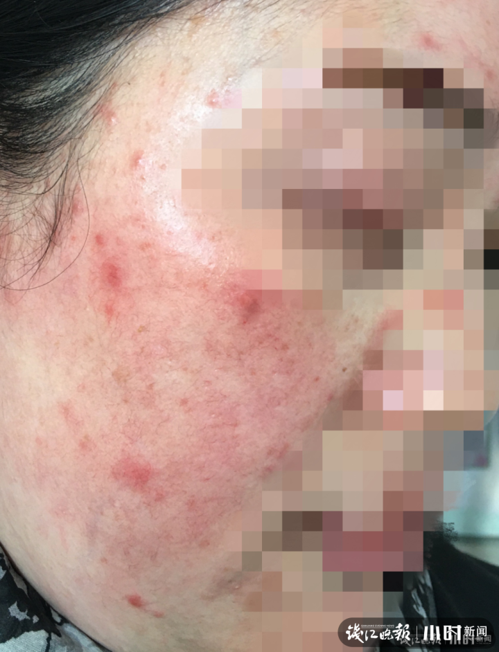 女同胞们，赶紧停用！女子突然“烂脸”，医生：每天接诊七八个
